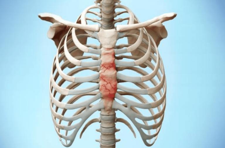 How Long Does It Take to Get Compensation for Fractured Sternum?